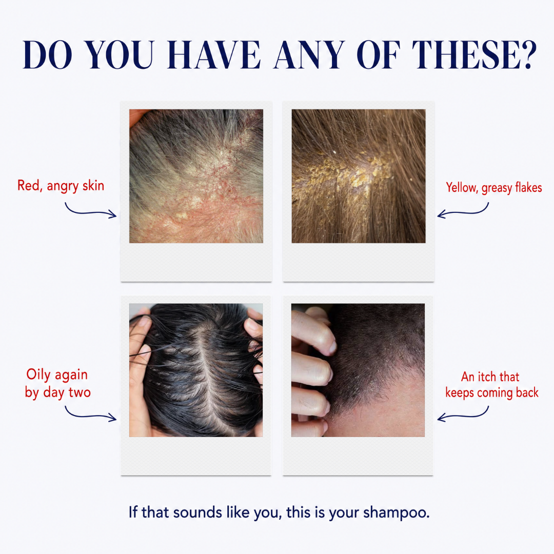 Anti-Dandruff Shampoo
